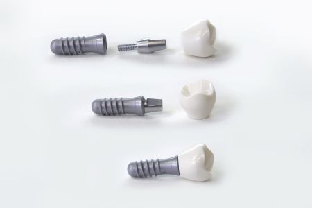 Ein Modell eines Zahnimplantats der Zahnarztpraxis Jguburia